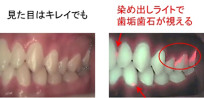 左:歯と歯茎の写真、右:染め出しライトで歯垢歯石が可視化され、該当箇所に矢印や丸印が表示されている写真