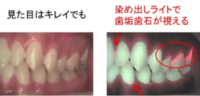 左：歯と歯茎の写真、右：染め出しライトで歯垢歯石が可視化され、該当箇所に矢印や丸印が表示されている写真